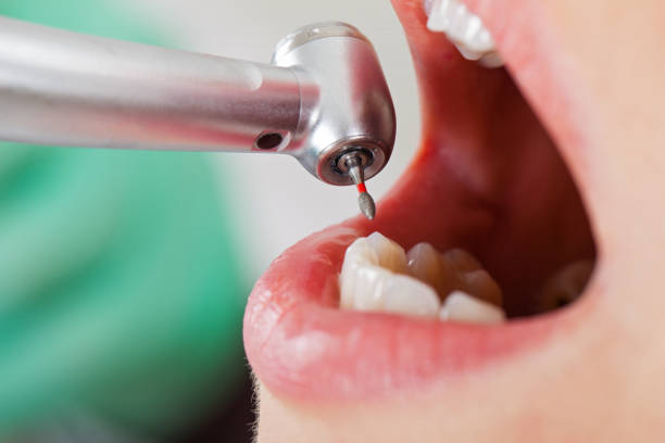 Best Chipped Tooth Repair Near Me  in Sandusky, OH